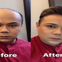Avatar: Hair fixing cost in singapore